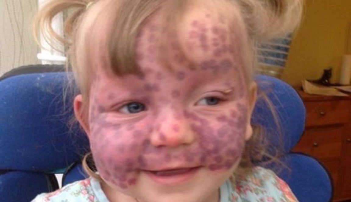 Baby Is Born With An Unusual Birthmark Soon Doctors Realize What It