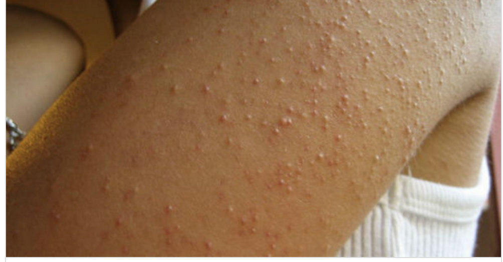 She Develops Itchy Red Bumps All Over Her Arms – But No One Knew It Was